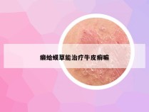 癞蛤蟆草能治疗牛皮癣嘛