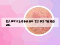 喜炎平可以治疗牛皮癣吗 喜炎平治疗尿路感染吗