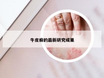 牛皮癣的最新研究成果