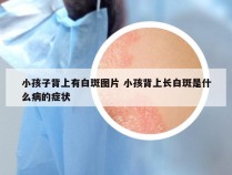 小孩子背上有白斑图片 小孩背上长白斑是什么病的症状