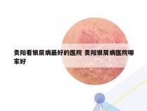 贵阳看银屑病最好的医院 贵阳银屑病医院哪家好