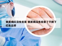 银屑病红没有皮屑 银屑病没有皮屑了只剩下红色丘疹