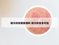 斯大林有银屑病吗 斯大林有多可怕