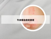牛皮癣治愈的表现