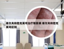 萌尔夫和他克莫司治疗银屑病 萌尔夫和他克莫司区别