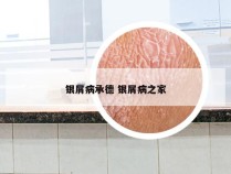 银屑病承德 银屑病之家