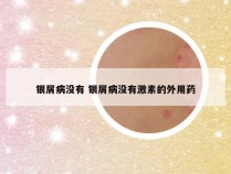 银屑病没有 银屑病没有激素的外用药