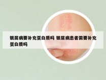 银屑病要补充蛋白质吗 银屑病患者需要补充蛋白质吗