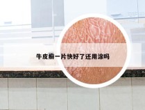 牛皮癣一片快好了还用涂吗