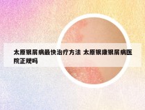 太原银屑病最快治疗方法 太原银康银屑病医院正规吗