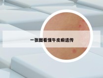 一张图看懂牛皮癣遗传