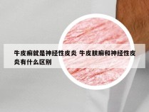 牛皮癣就是神经性皮炎 牛皮肤癣和神经性皮炎有什么区别