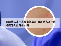 银屑病头上一直掉皮怎么办 银屑病头上一直掉皮怎么办用什么药