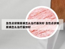 急性点状银屑病怎么治疗最快好 急性点状银屑病怎么治疗最快好