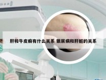 肝和牛皮癣有什么关系 银屑病和肝脏的关系