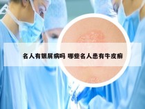 名人有银屑病吗 哪些名人患有牛皮癣