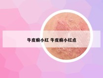 牛皮癣小红 牛皮癣小红点