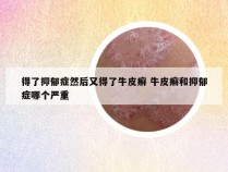 得了抑郁症然后又得了牛皮癣 牛皮癣和抑郁症哪个严重