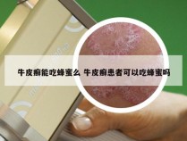 牛皮癣能吃蜂蜜么 牛皮癣患者可以吃蜂蜜吗