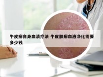 牛皮癣自身血清疗法 牛皮肤癣血液净化需要多少钱