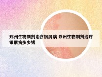 郑州生物制剂治疗银屑病 郑州生物制剂治疗银屑病多少钱