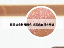 银屑病会长母斑吗 银屑病有没有母斑