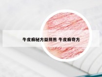 牛皮癣秘方益阴煎 牛皮癣奇方