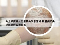 头上银屑病长出来的头发非常细 银屑病长头上怎治疗头发很长
