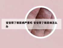 宝宝得了银屑病严重吗 宝宝得了银屑病怎么办