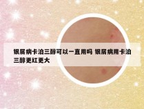 银屑病卡泊三醇可以一直用吗 银屑病用卡泊三醇更红更大
