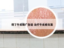 得了牛皮癣广告语 治疗牛皮癣文案
