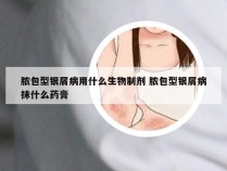 脓包型银屑病用什么生物制剂 脓包型银屑病抹什么药膏