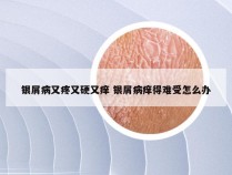 银屑病又疼又硬又痒 银屑病痒得难受怎么办