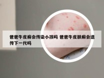 爸爸牛皮癣会传染小孩吗 爸爸牛皮肤癣会遗传下一代吗