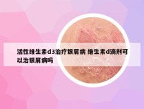 活性维生素d3治疗银屑病 维生素d滴剂可以治银屑病吗