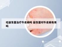 吃益生菌治疗牛皮癣吗 益生菌对牛皮癣有用吗