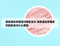 银屑病皮疹睡觉时颜色变淡 银屑病皮疹睡觉时颜色变淡什么原因