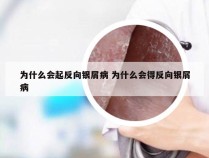 为什么会起反向银屑病 为什么会得反向银屑病