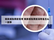 银屑病角质层变薄 银屑病角质层深厚是怎么一回事