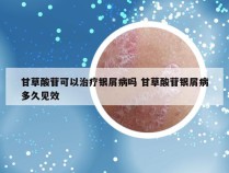 甘草酸苷可以治疗银屑病吗 甘草酸苷银屑病多久见效