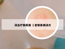 汤治疗银屑病 禤老银屑病汤方