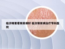 临沂哪里看银屑病好 临沂银屑病治疗专科医院