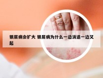银屑病会扩大 银屑病为什么一边消退一边又起
