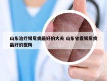 山东治疗银屑病最好的大夫 山东省看银屑病最好的医院