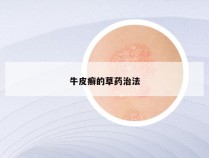牛皮癣的草药治法