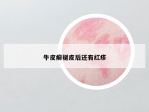 牛皮癣褪皮后还有红疹