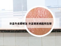 许昌牛皮癣吧友 许昌银屑病医院在那