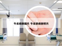牛皮癣脚图片 牛皮肤癣脚照片