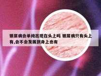 银屑病会单纯出现在头上吗 银屑病只有头上有,会不会发展到身上也有