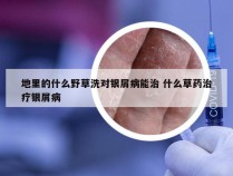 地里的什么野草洗对银屑病能治 什么草药治疗银屑病